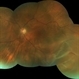 RD With Posterior Tear RD With Posterior Tear